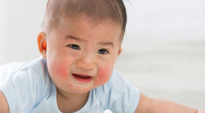 ជំងឺសើរស្បែកលើក្មេងតូចៗបង្កដោយអ្វី? តើគួរដោះស្រាយយ៉ាងដូចម្ដេចទៅ?